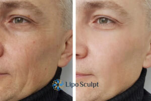 How to Fight Aging Symptoms 3 Fight Aging Symptoms Girton With HIFU and Morpheus8 Today!