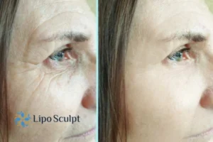 How to Fight Aging Symptoms 2 Do you want to Fight Aging Symptoms Girton? Contact Lipo Sculpt today!