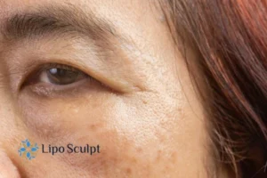 Cryopen: The Revolutionary Treatment for Age Spots Unveiled 2 Are age spots Girton giving you low self esteem? Contact us today!